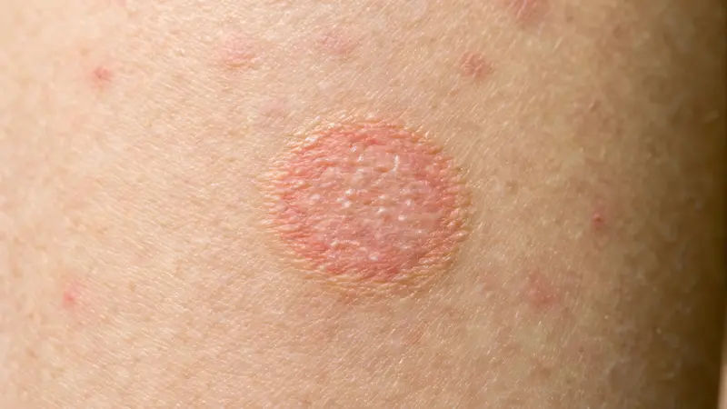 What Leads to Signs of Skin Infections A Complete Guide